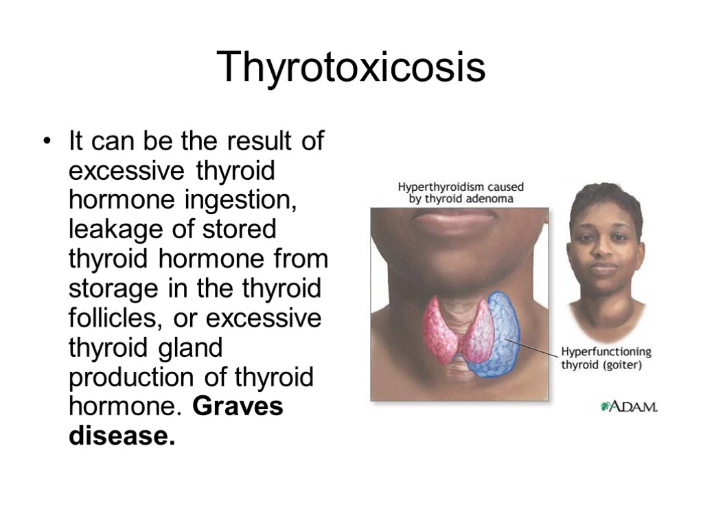 Thyrotoxicosis It can be the result of excessive thyroid hormone ingestion, leakage of stored